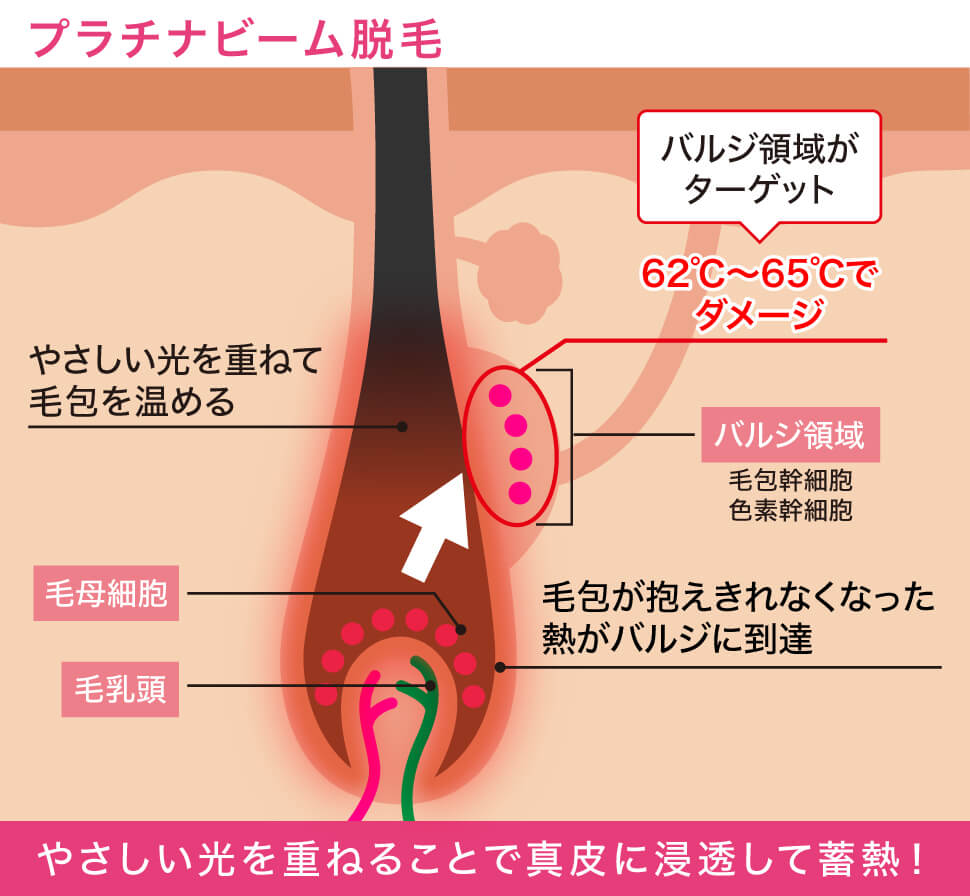 プラチナビーム脱毛のイメージ画像